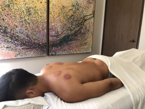 The marks produced by cupping have therapeutic benefits