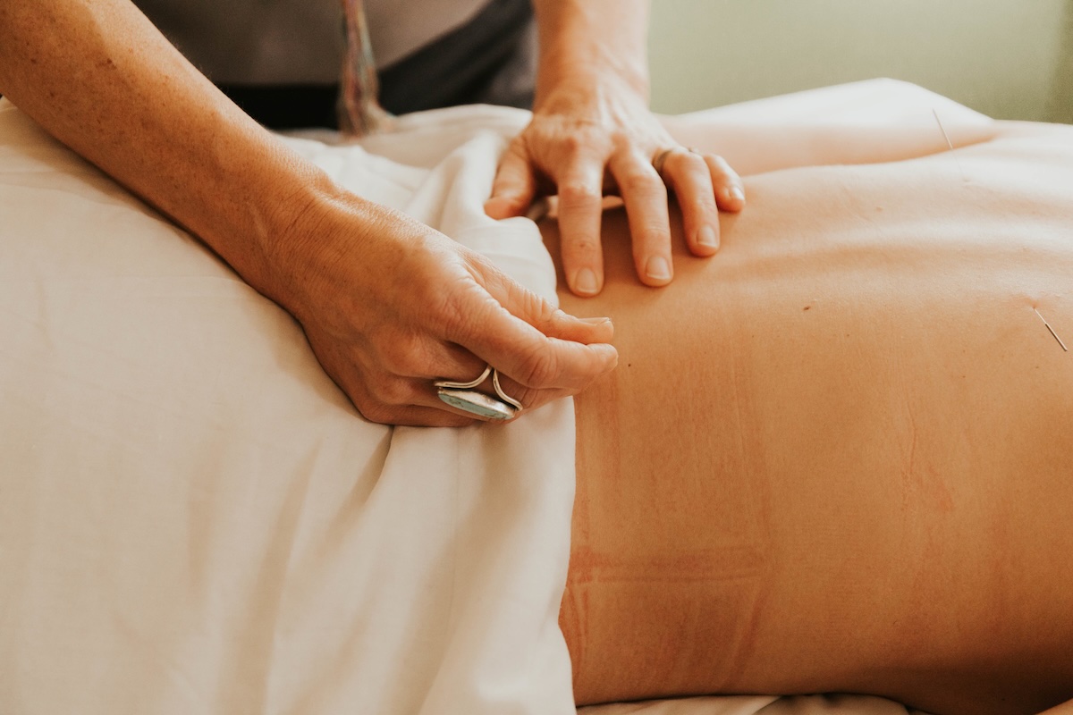 Acupuncturist performing motor point needling treatment on patient's low back in San Diego