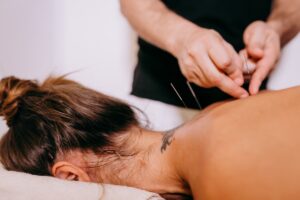 Acupuncturist needling upper back